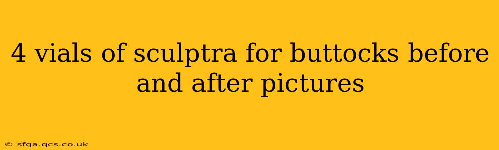 4 vials of sculptra for buttocks before and after pictures