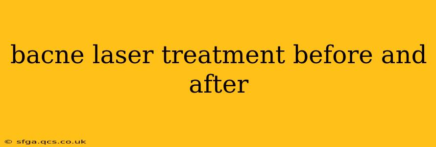 bacne laser treatment before and after