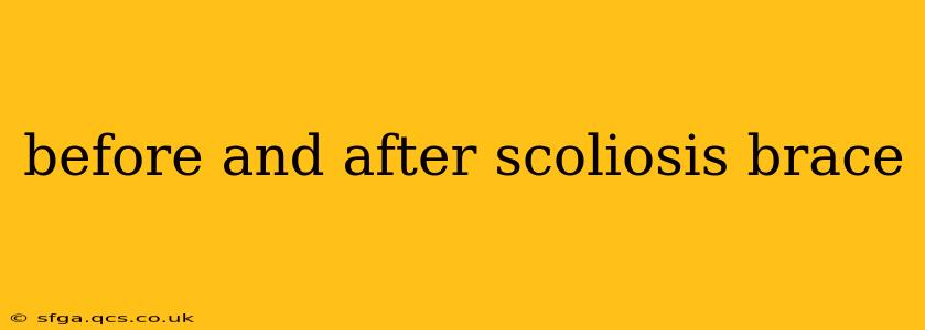 before and after scoliosis brace
