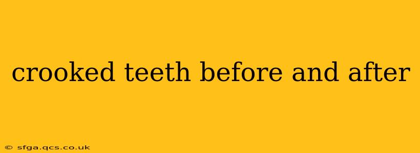 crooked teeth before and after