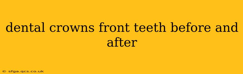 dental crowns front teeth before and after
