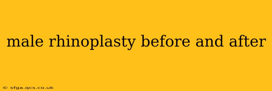 male rhinoplasty before and after
