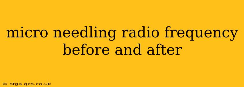 micro needling radio frequency before and after
