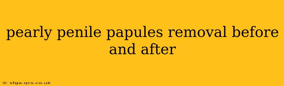 pearly penile papules removal before and after