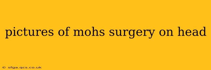 pictures of mohs surgery on head
