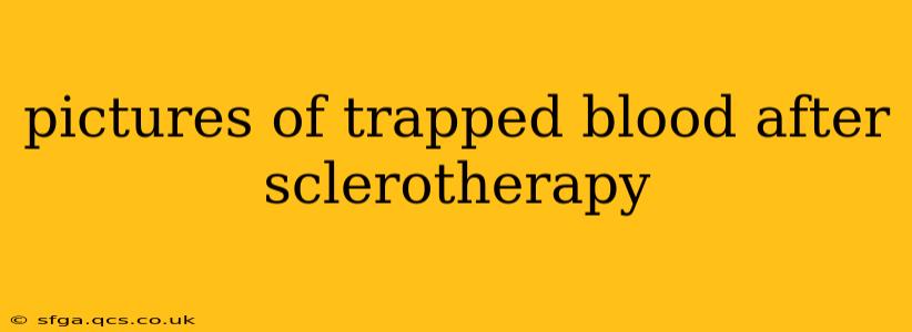pictures of trapped blood after sclerotherapy